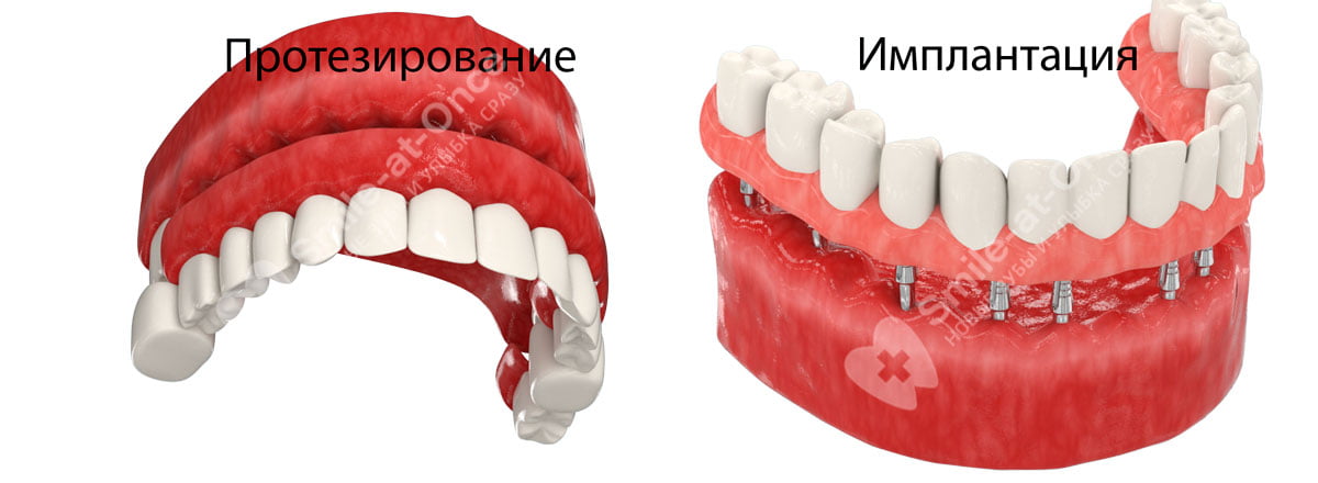 зубные имплантаты straumann. имплантат нобель 3. винтовой имплантат alpha bio. разница в имплантах. базальная имплантация зубов (basal complex).